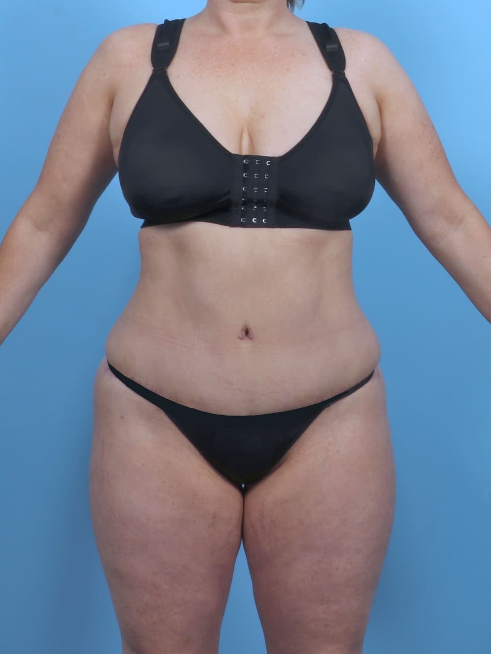 Liposuction case #5092 after