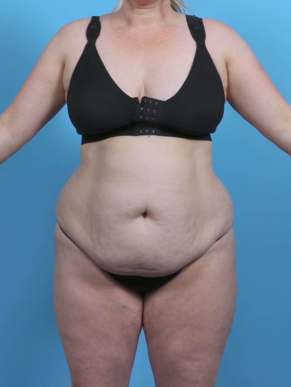 Liposuction case #5092 before