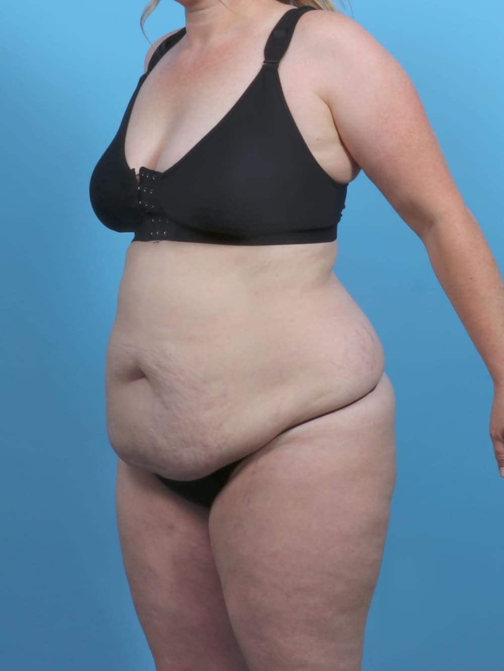 Tummy Tuck case #5092 before, image 2