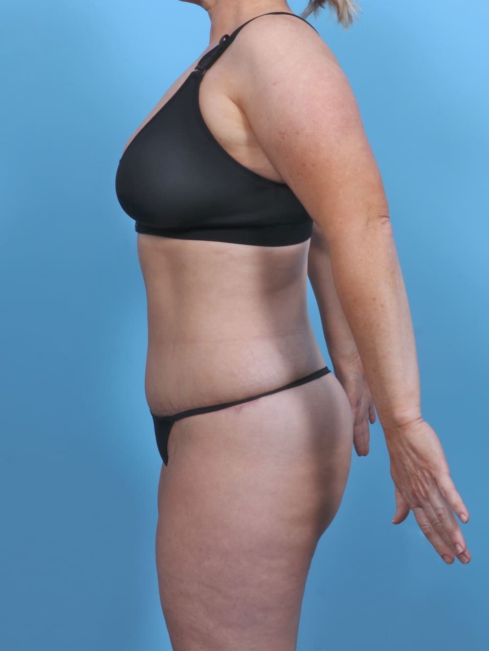 Tummy Tuck case #5092 after, image 3