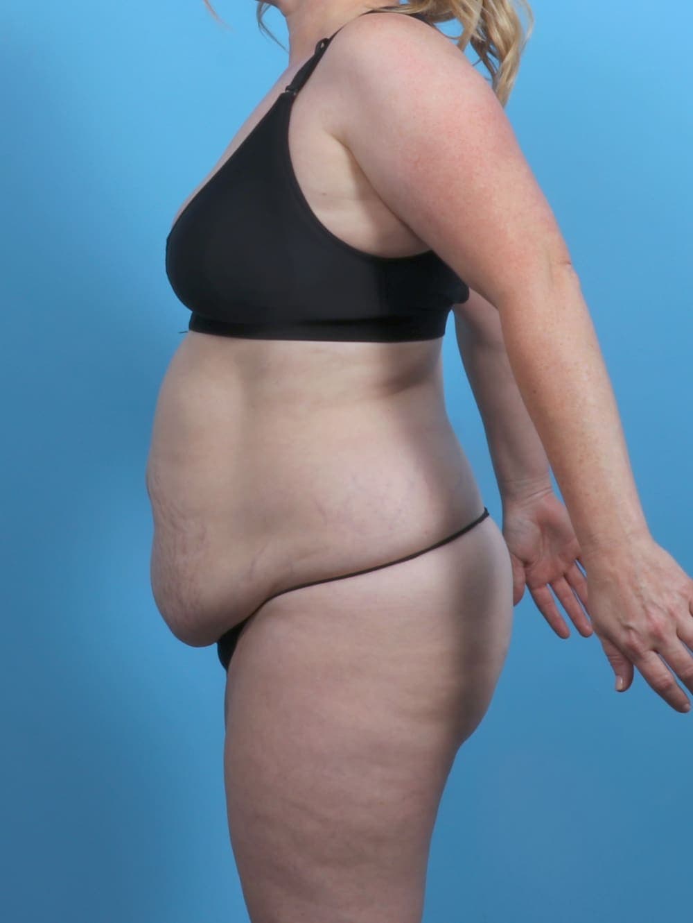 Tummy Tuck case #5092 before, image 3