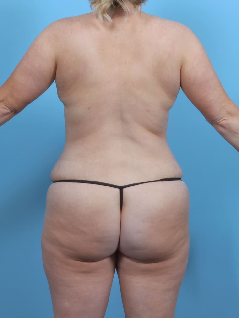 Tummy Tuck case #5092 after, image 4