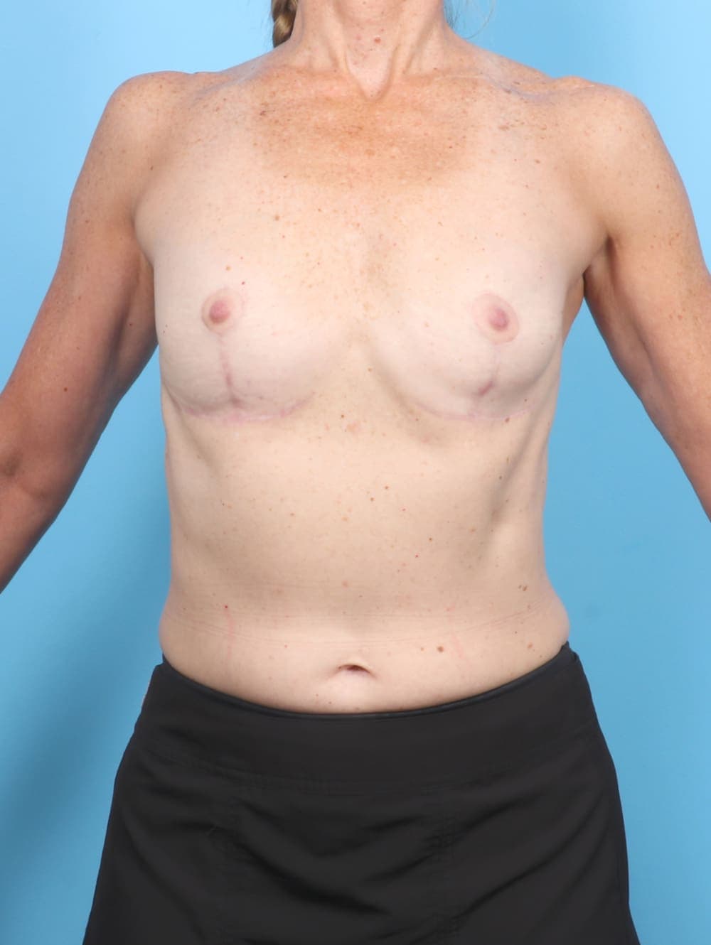 Breast Implant Removal with Lift case #6933 after, image 1