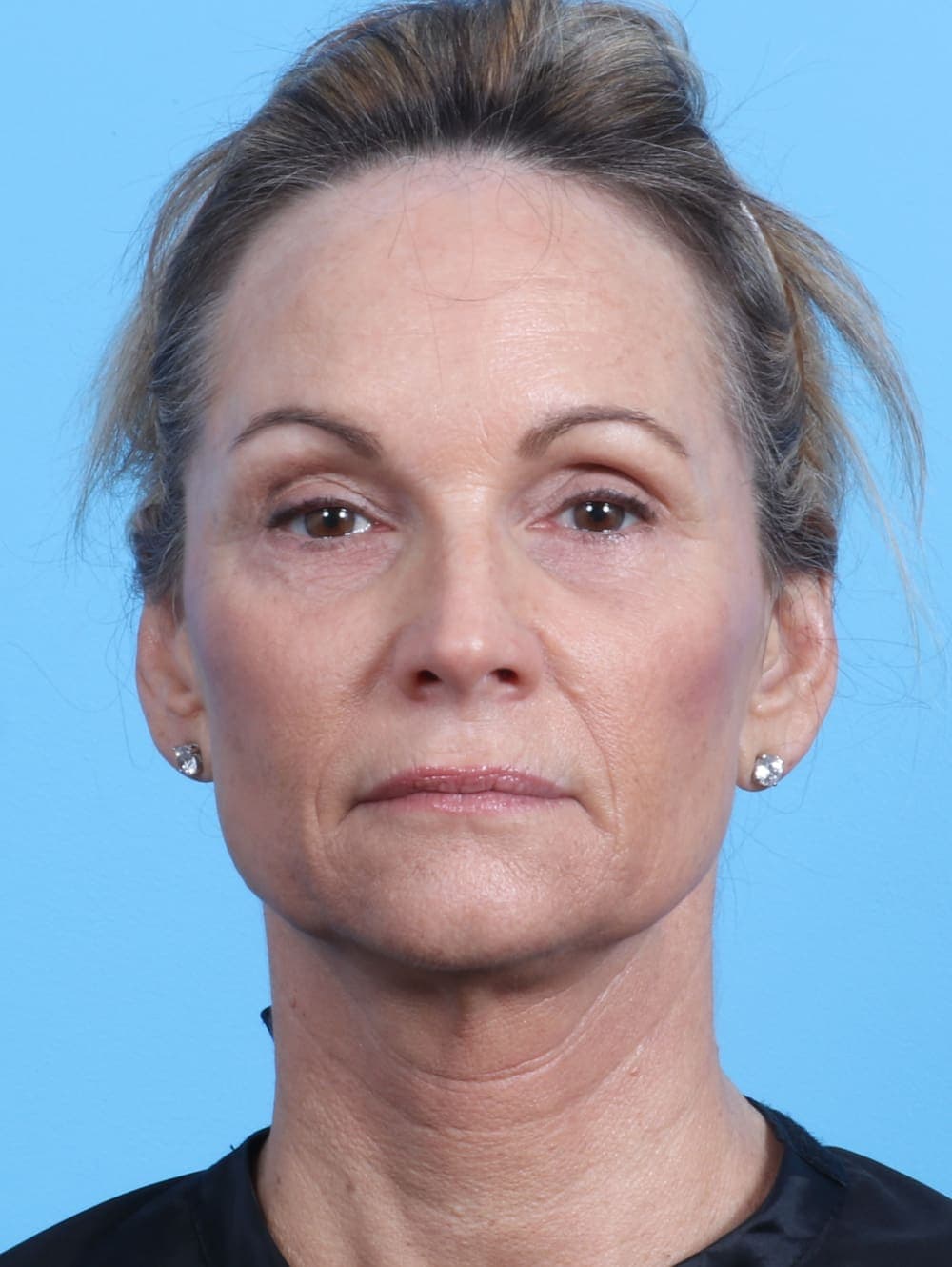 Eyelid Surgery case #2647 after