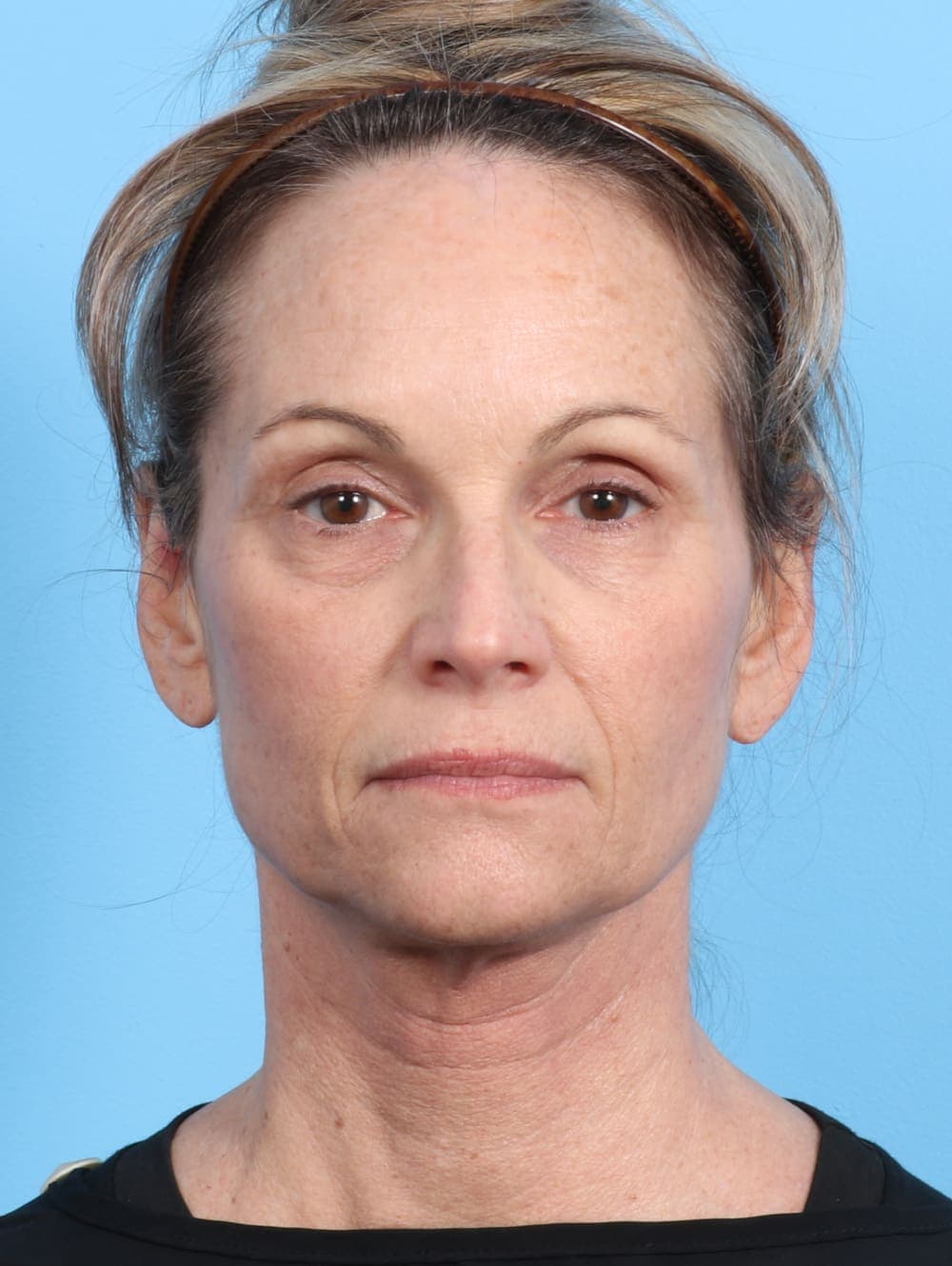 Eyelid Surgery case #2647 before