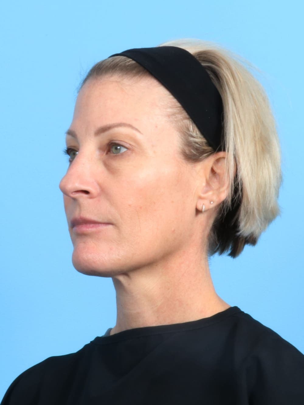 Eyelid Surgery case #2420 before, image 2