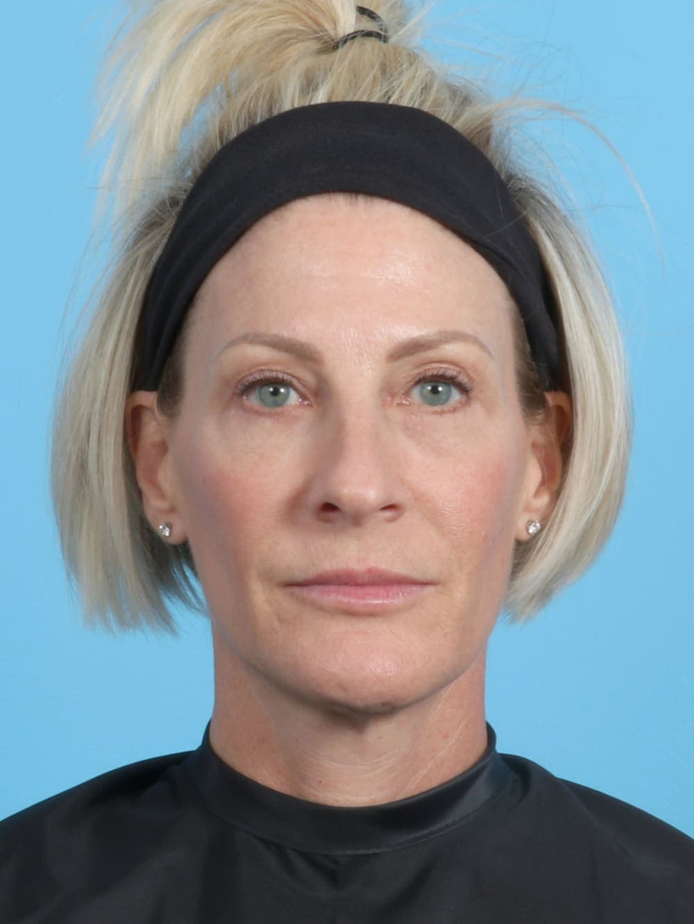 Eyelid Surgery case #2420 after