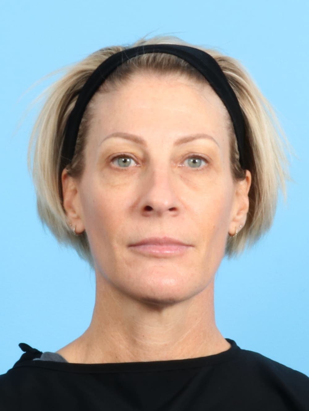 Eyelid Surgery case #2420 before