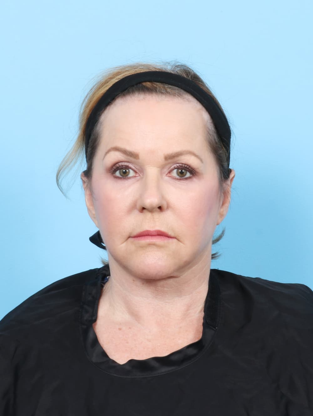Facial Surgery case #7509 after
