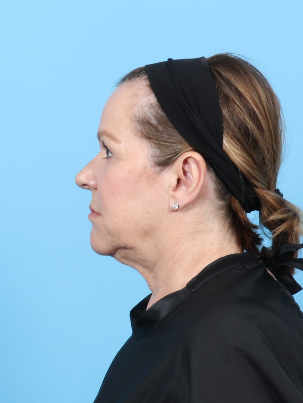Facelift case #7509 before, image 3