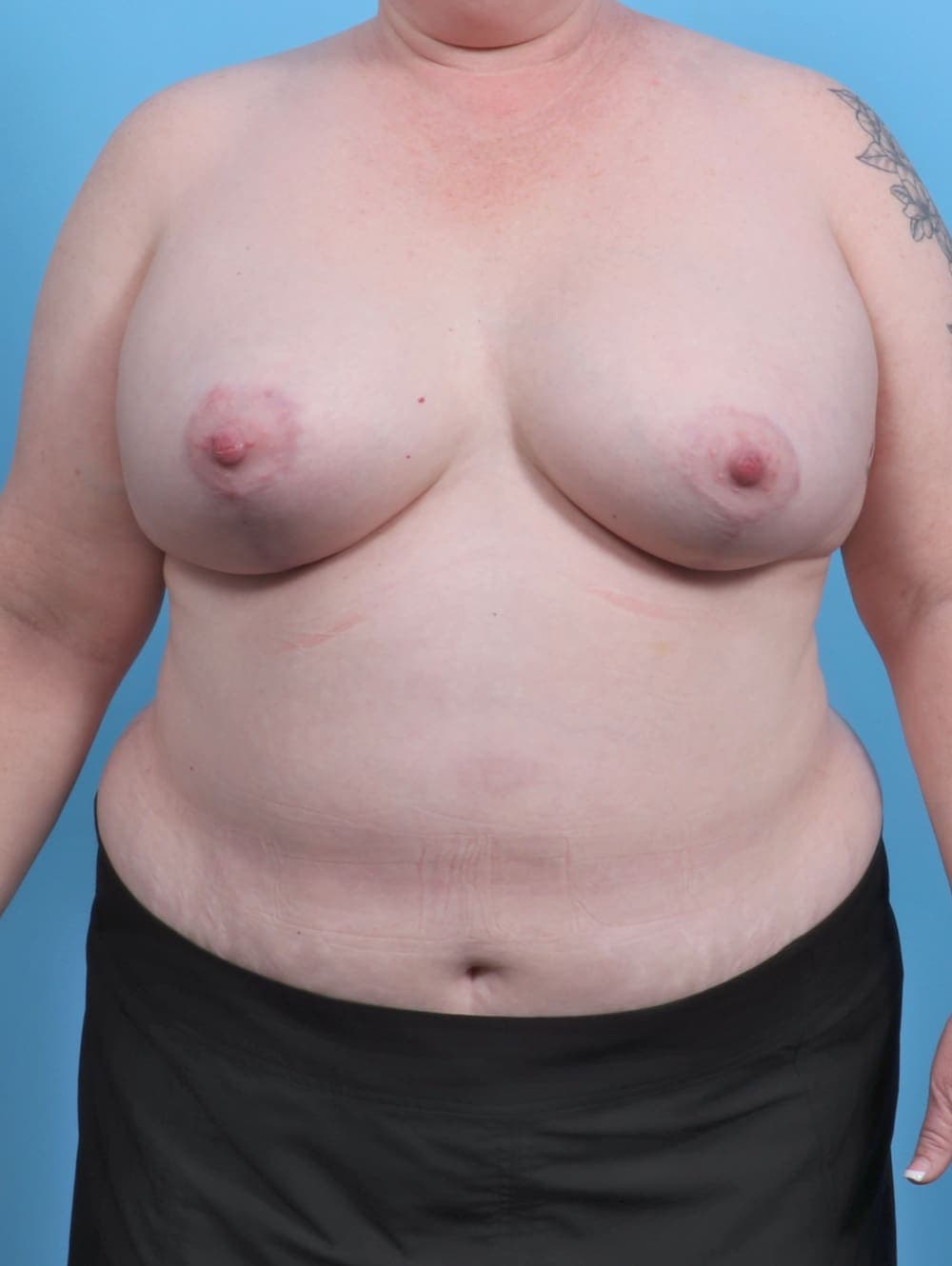 Breast Lift with Implants case #4363 after