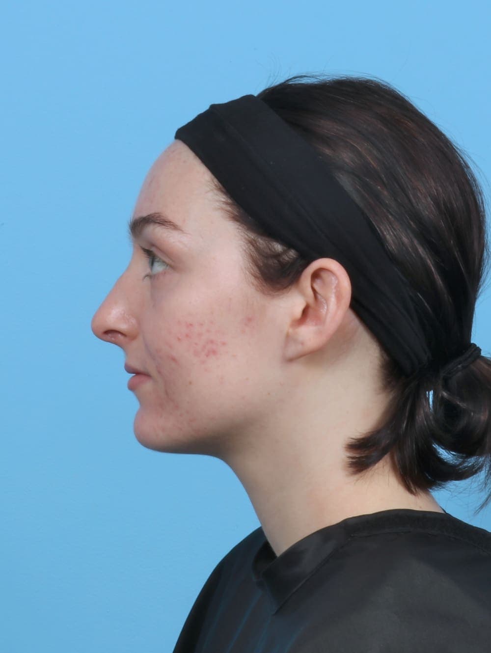 Facial Surgery case #5103 after