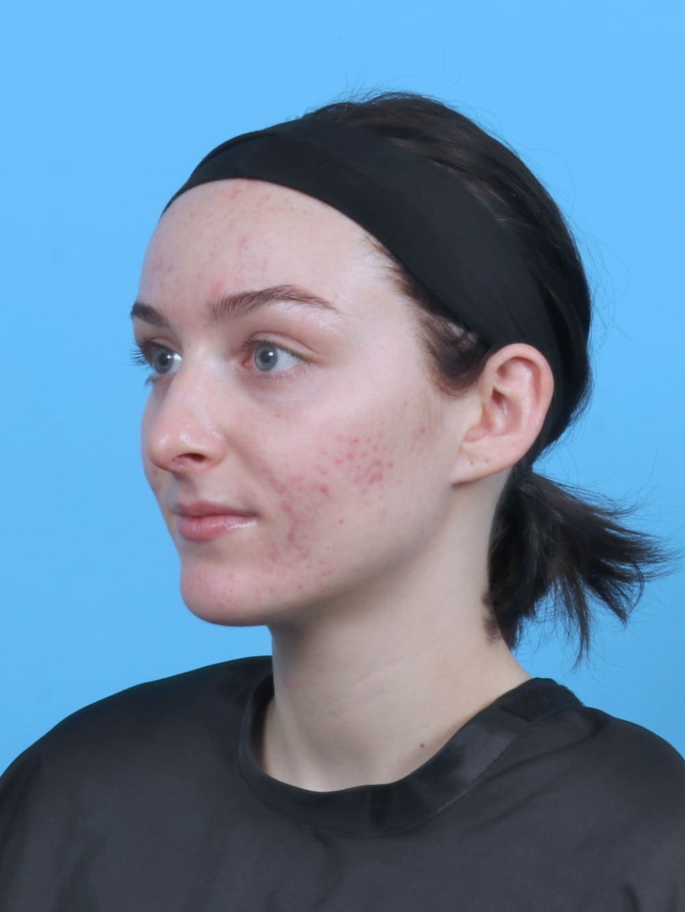 Rhinoplasty case #5103 after, image 3