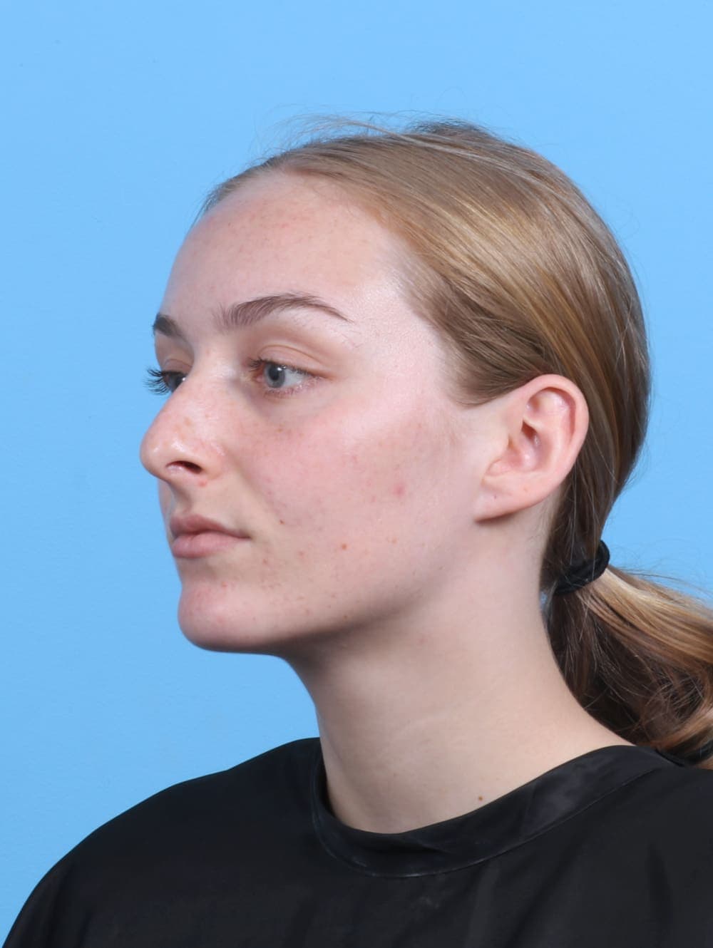 Rhinoplasty case #5103 before, image 3