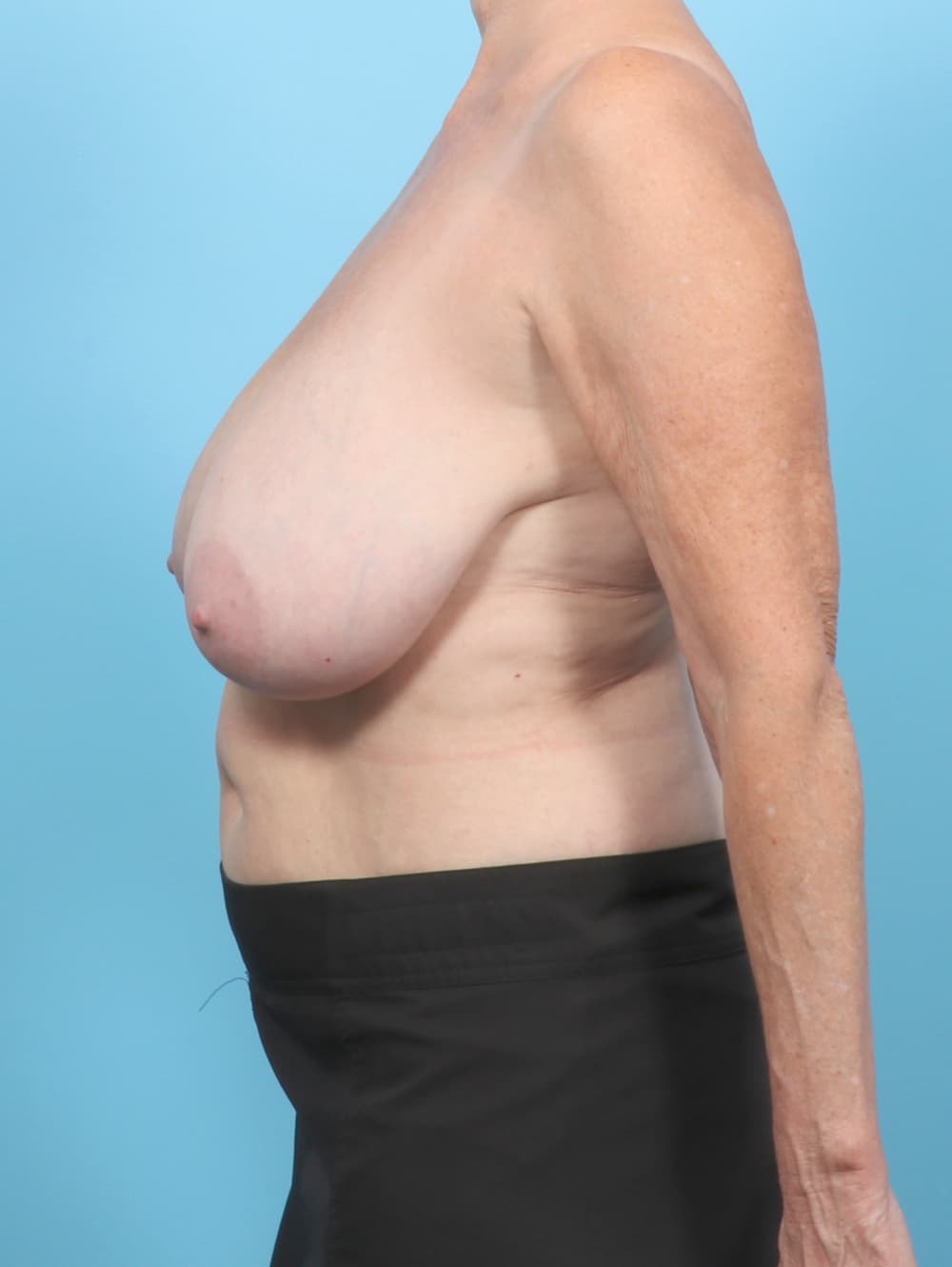 Breast Lift/Reduction case #7855 before, image 3
