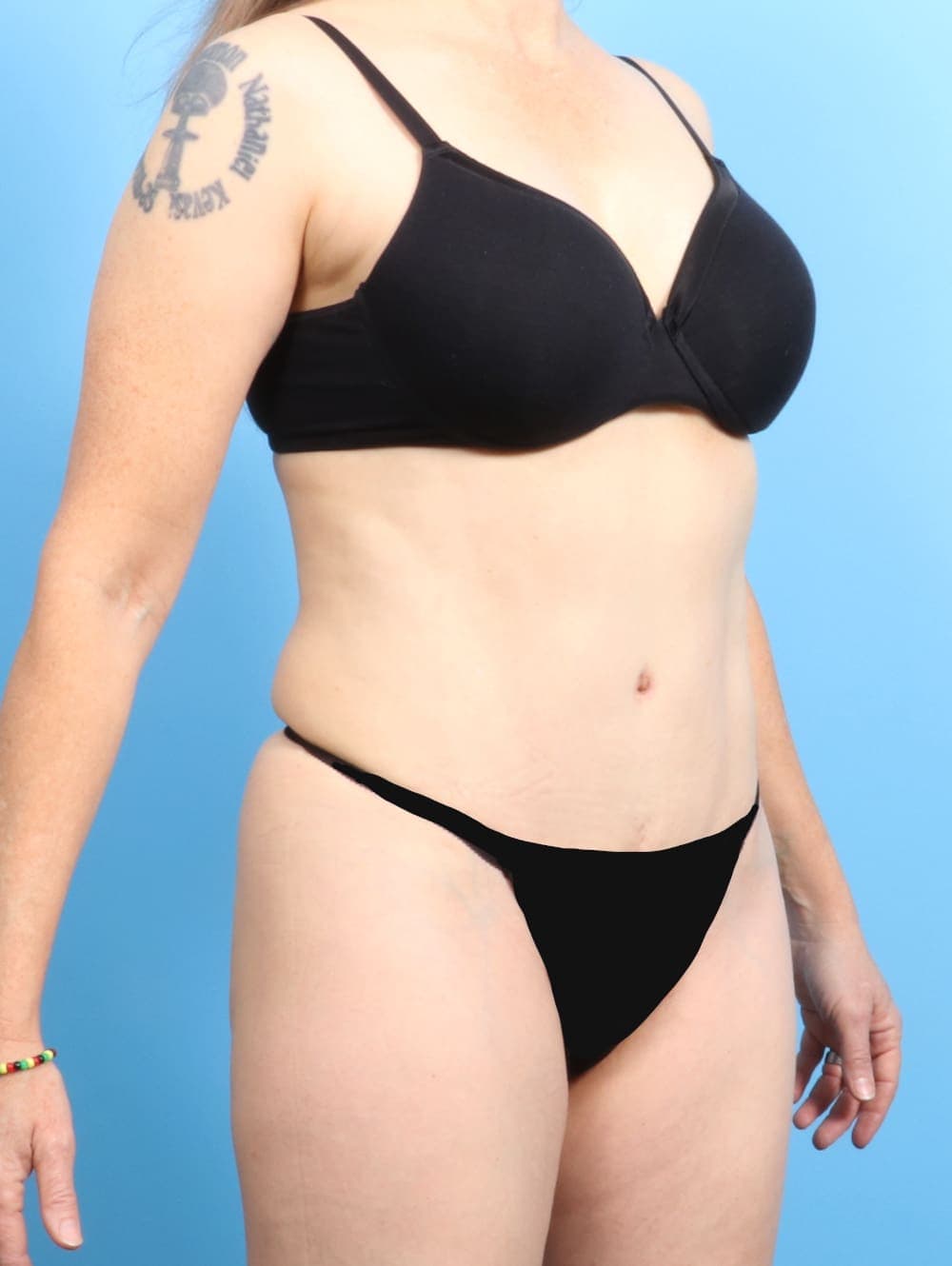 Tummy Tuck case #2282 after, image 2