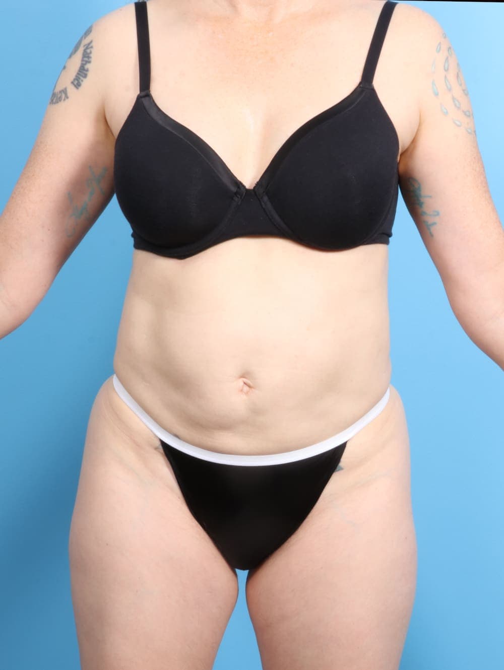 Tummy Tuck case #2282 before, image 1