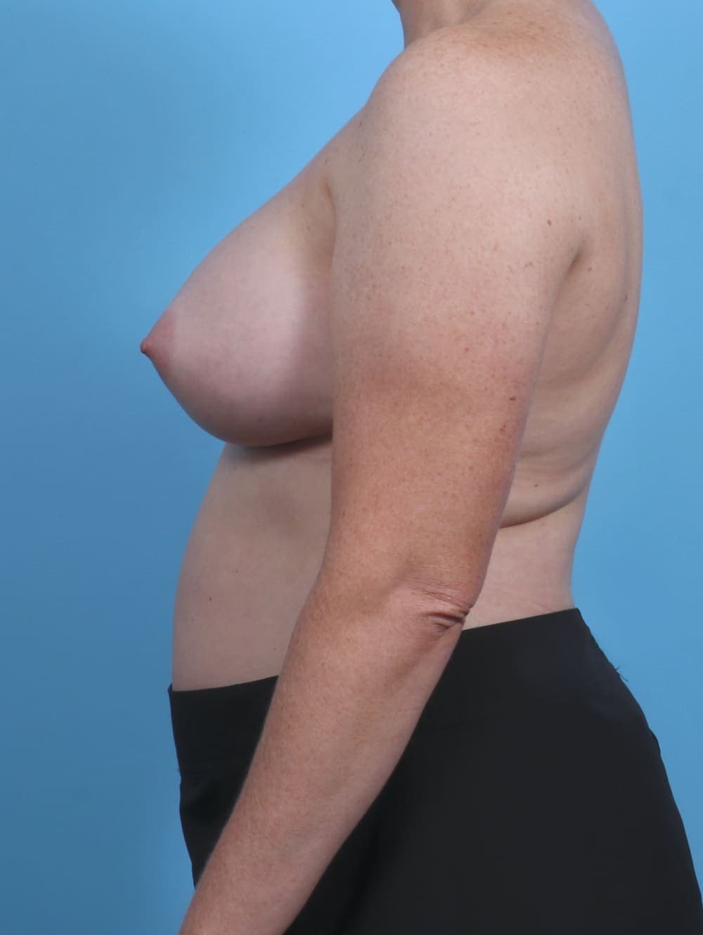 Breast Augmentation case #4091 after, image 3