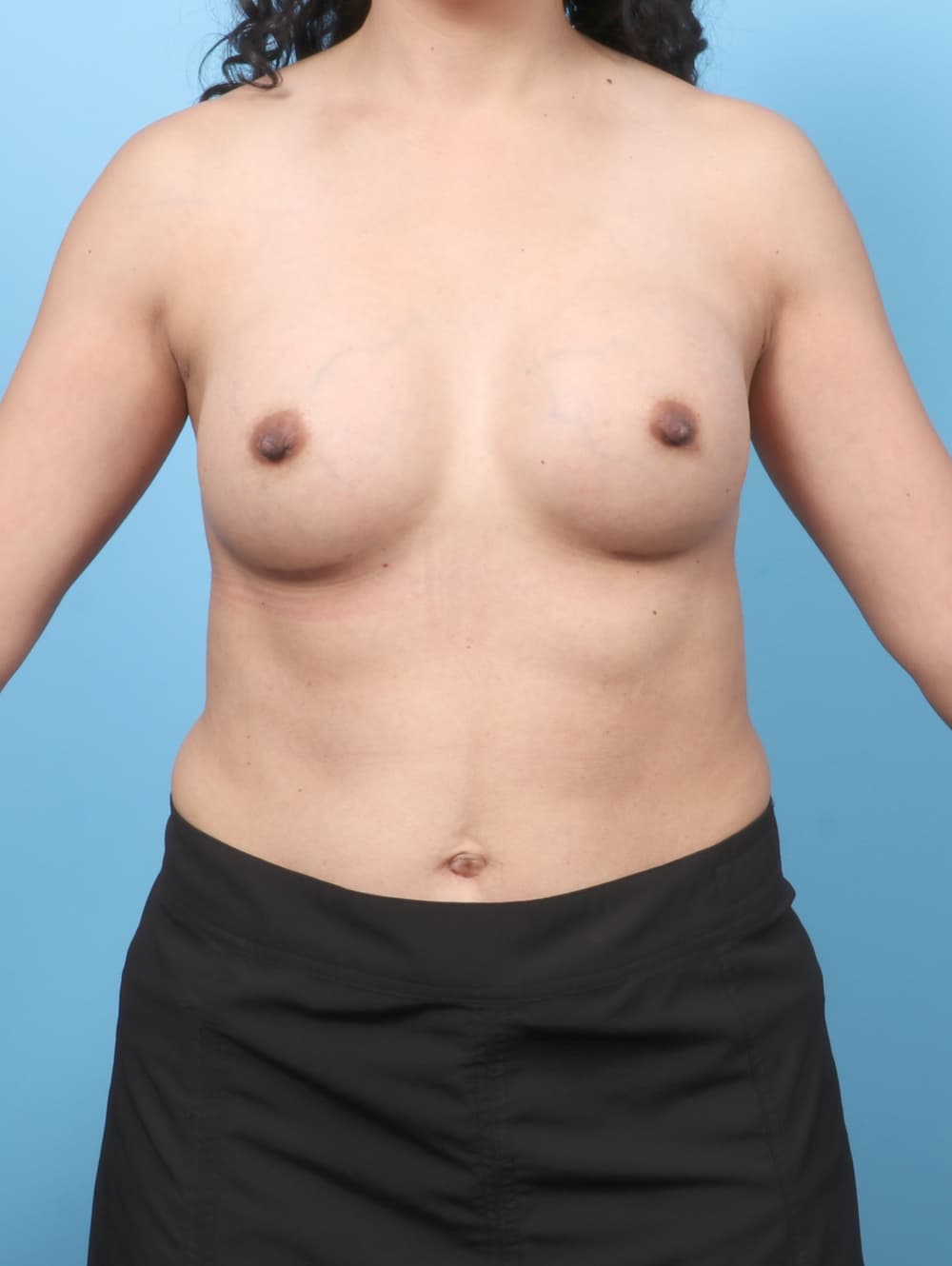 Breast Enhancement case #8110 after