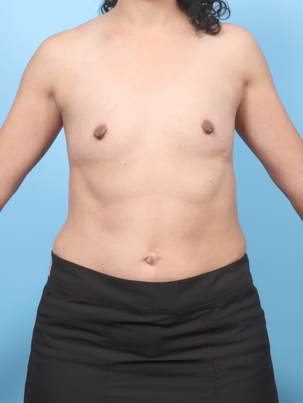 Breast Enhancement case #8110 before