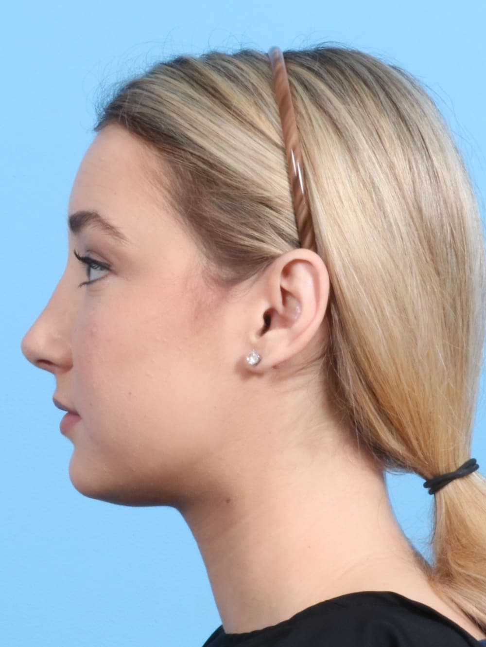 Rhinoplasty case #2240 after