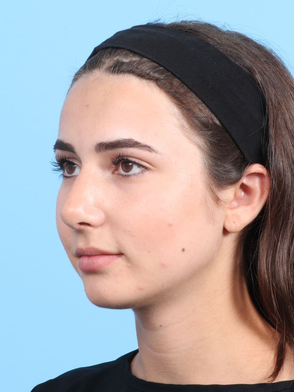 Rhinoplasty case #2679 after, image 3
