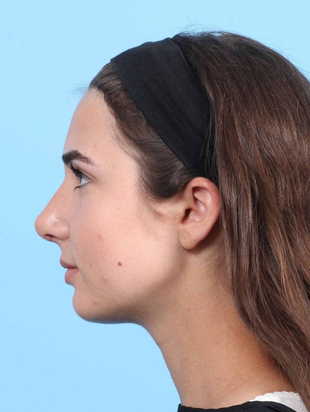 Rhinoplasty case #2679 after