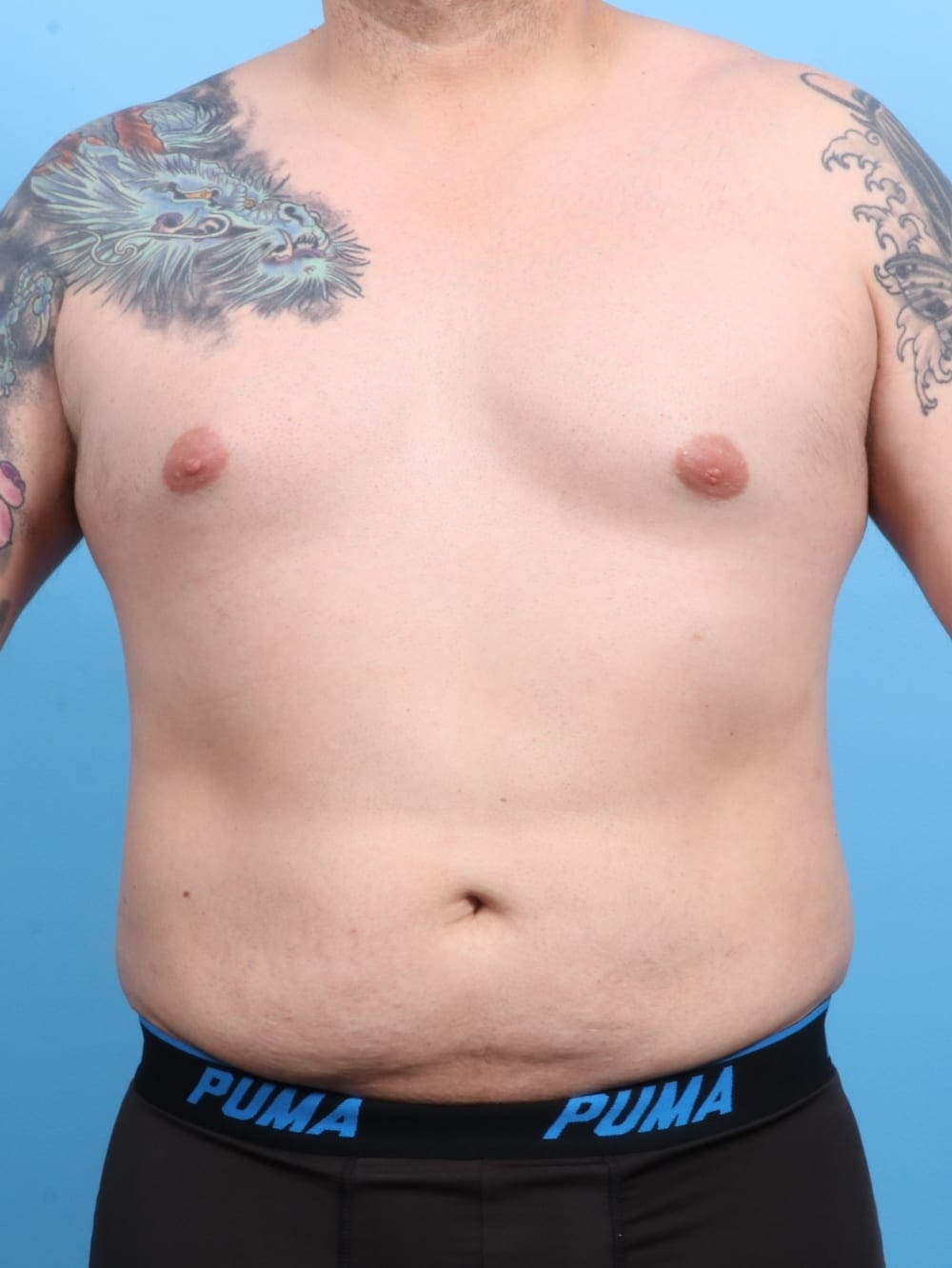 Liposuction case #1220 after