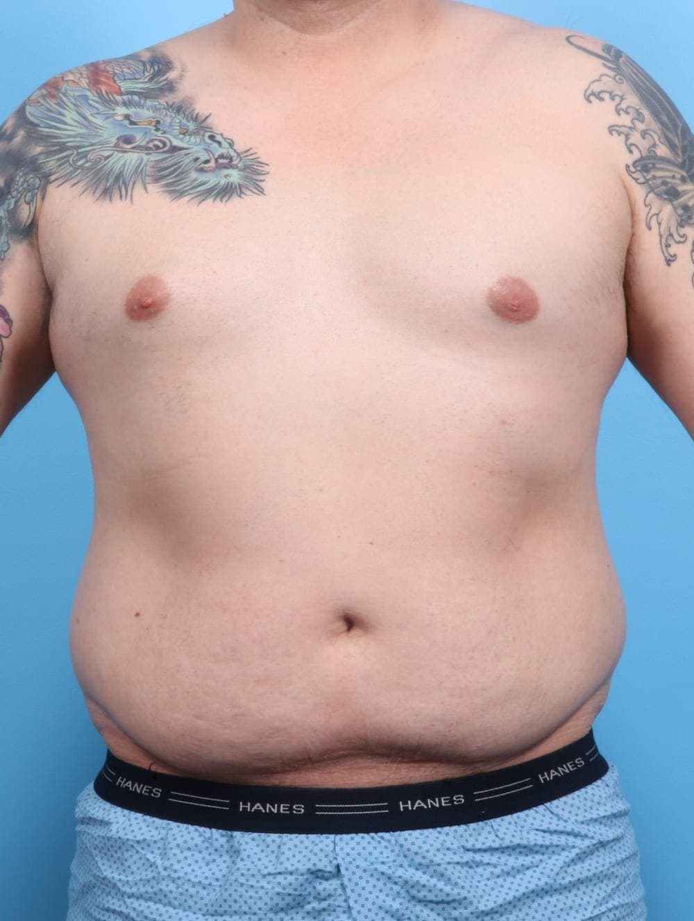 Liposuction case #1220 before