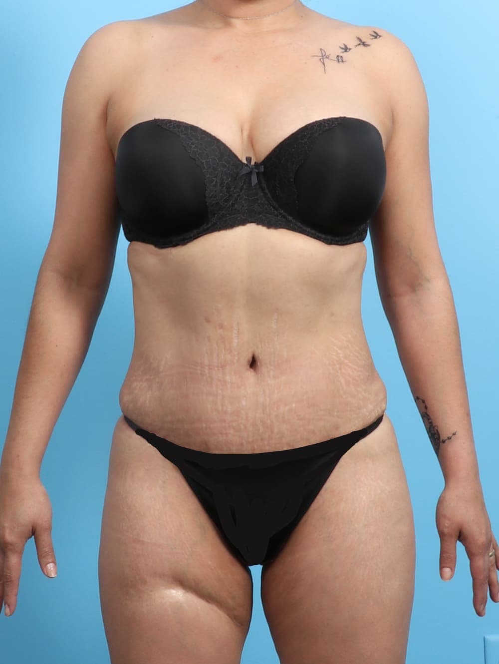 Liposuction case #2298 after