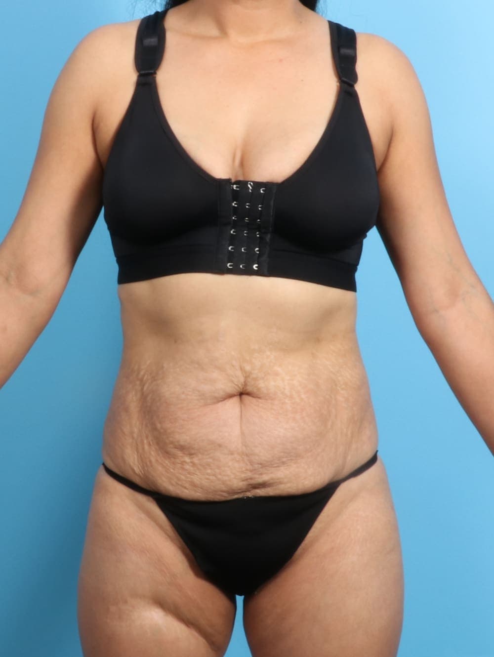 Liposuction case #2298 before