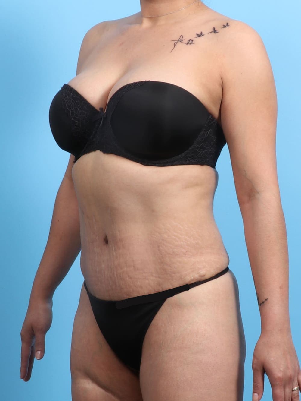 Liposuction case #2298 after, image 2