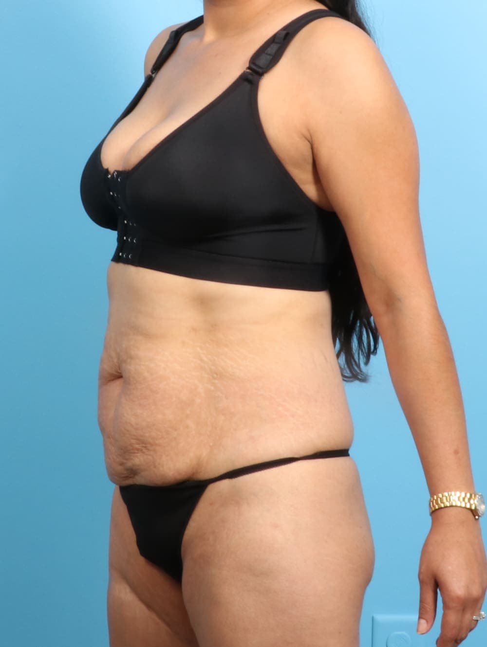 Liposuction case #2298 before, image 2
