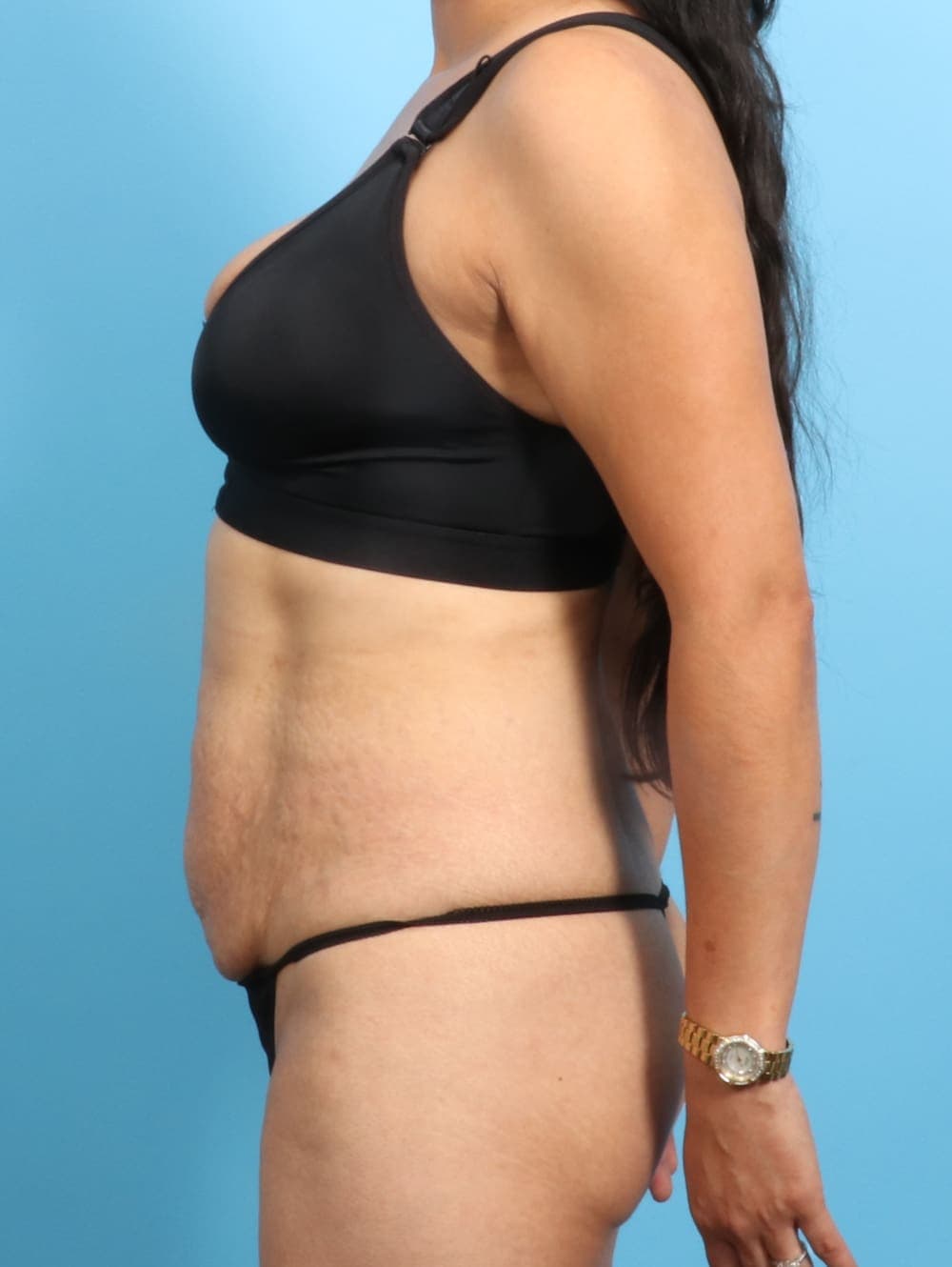Liposuction case #2298 before, image 3