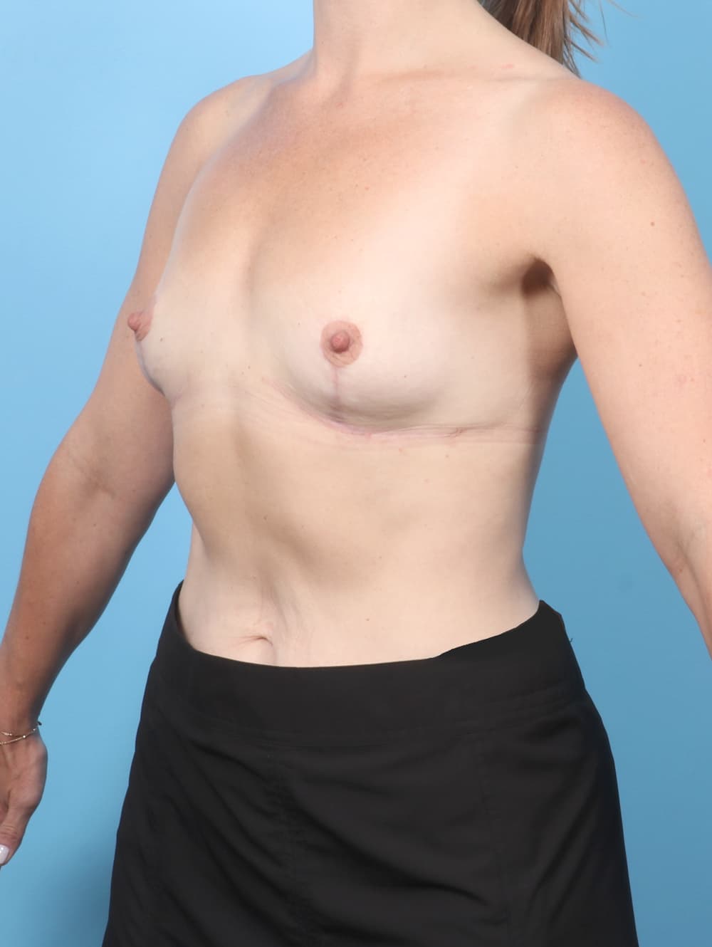 Breast Implant Removal with Lift case #7936 after, image 2