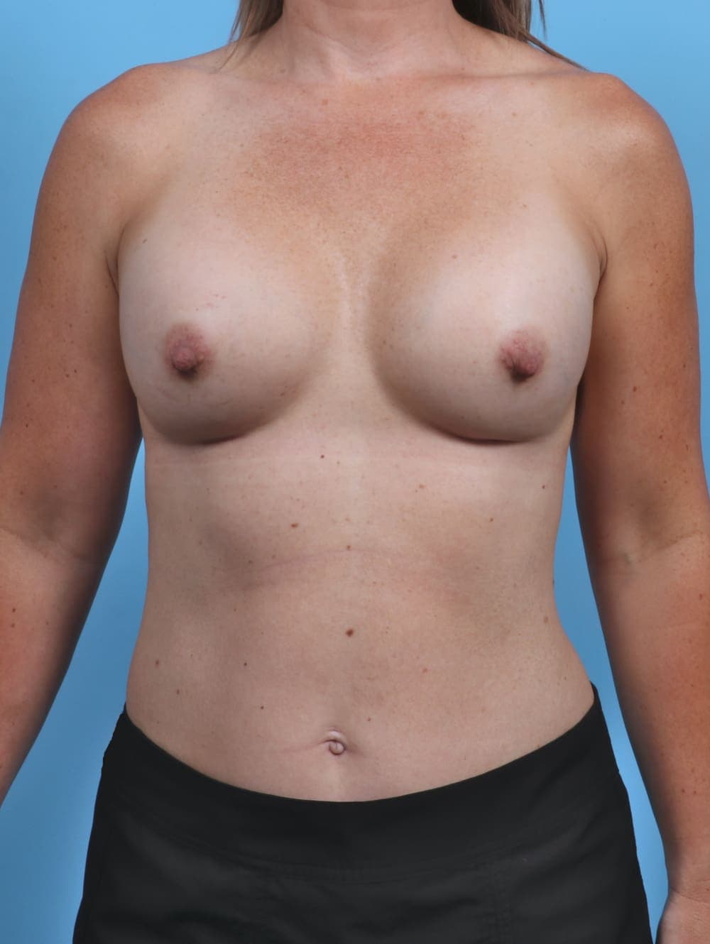 Breast Augmentation case #3819 after, image 1