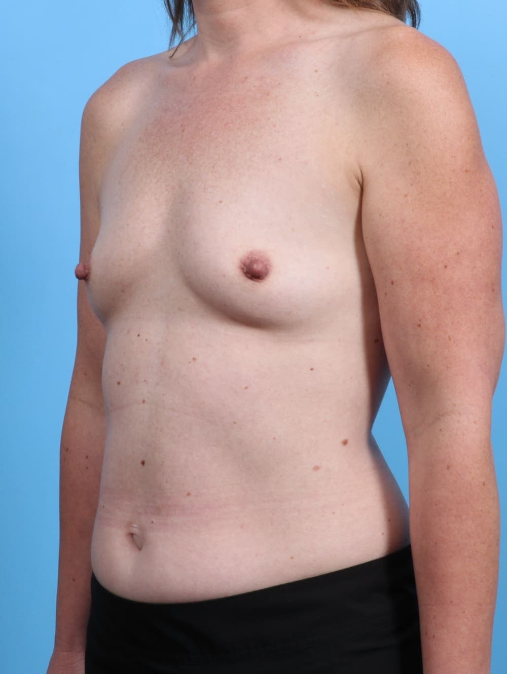 Breast Augmentation case #3819 before, image 2