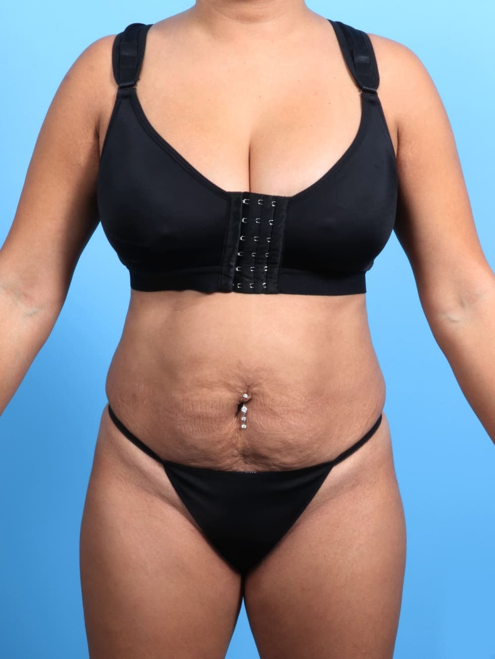Tummy Tuck case #2362 before, image 1