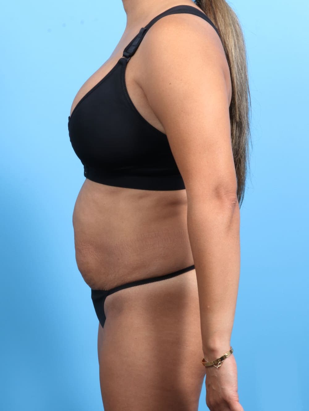 Tummy Tuck case #2362 before, image 3