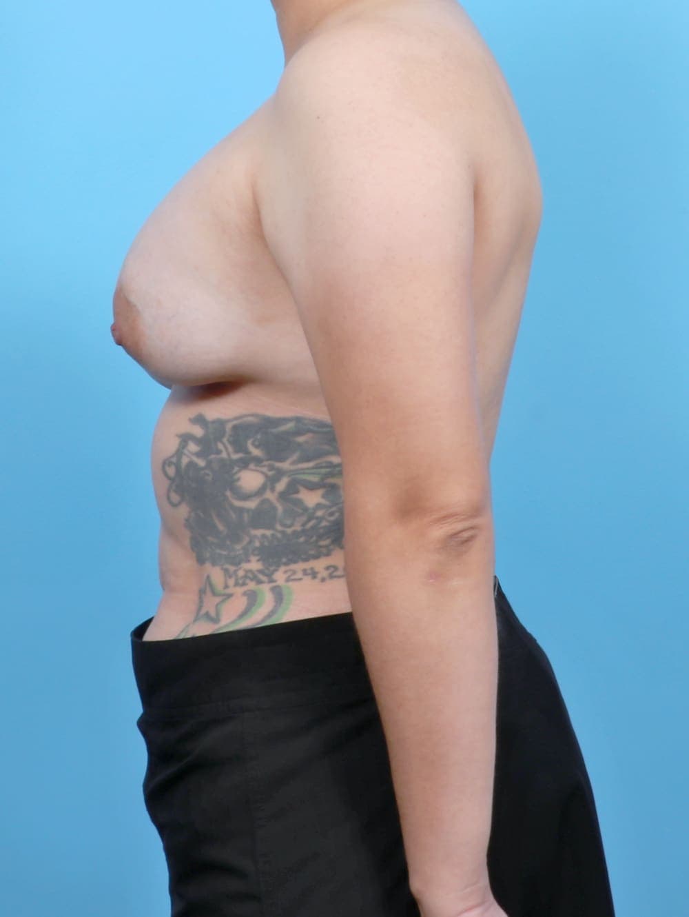 Breast Implant Revision case #6245 before, image 3