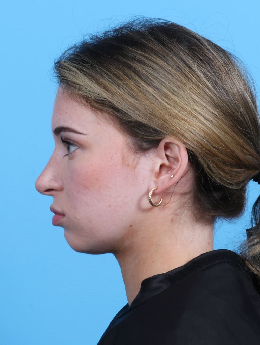 Facial Surgery case #3153 after