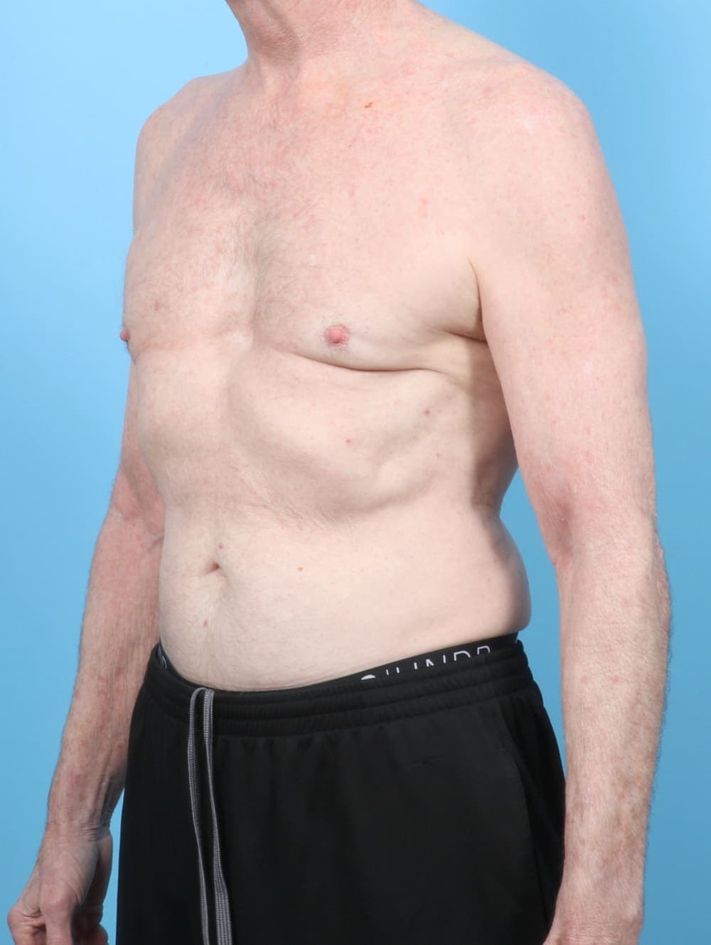 Male Breast Reduction case #6443 after, image 2