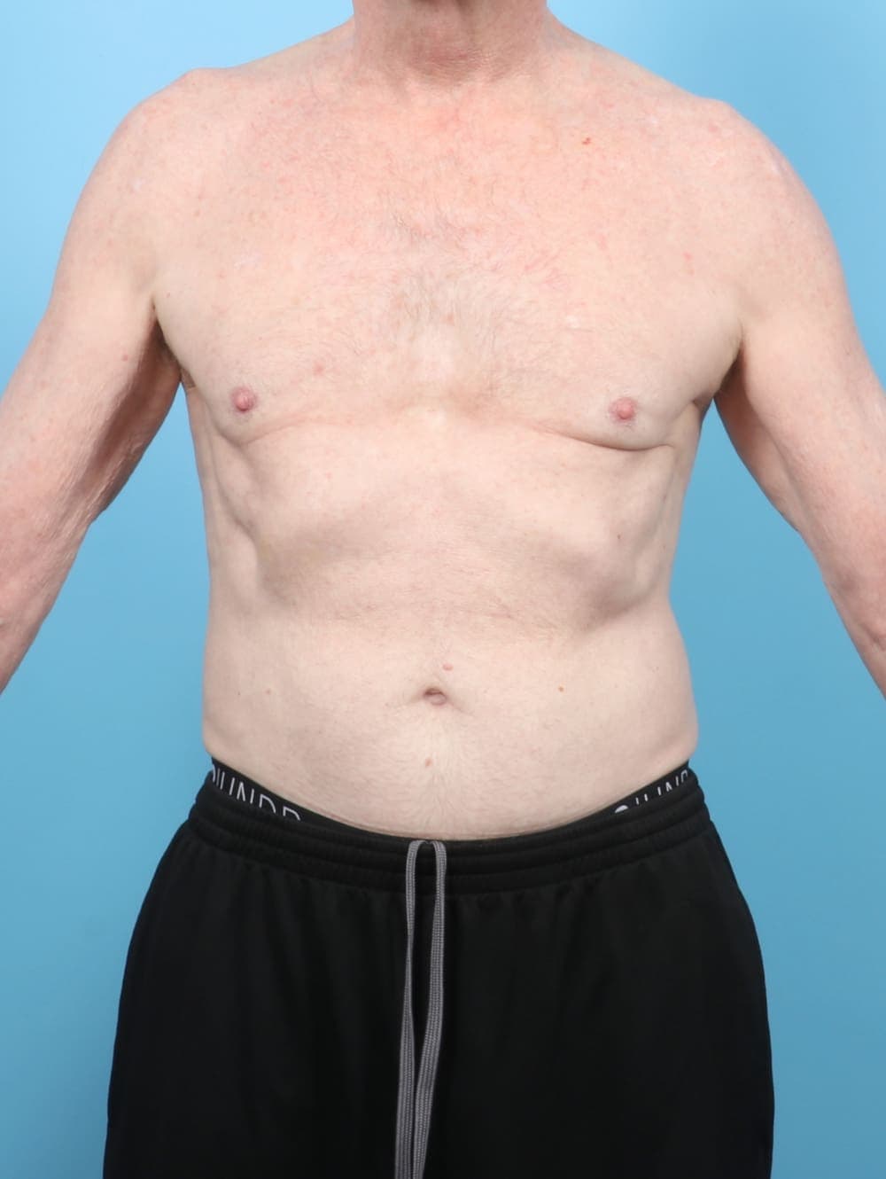 Male Breast Reduction case #6443 after, image 1