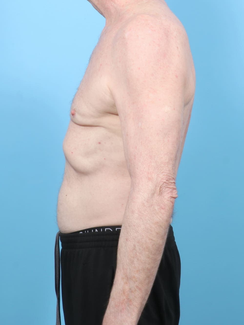 Male Breast Reduction case #6443 after, image 3