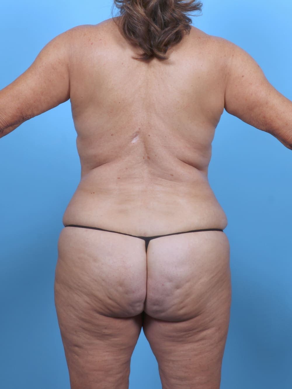 Mommy Makeover case #5847 after, image 4