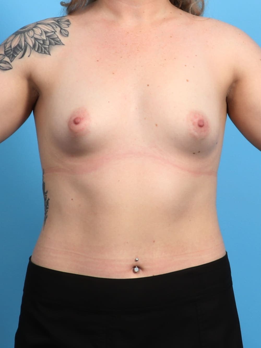 Breast Augmentation case #2889 before, image 1