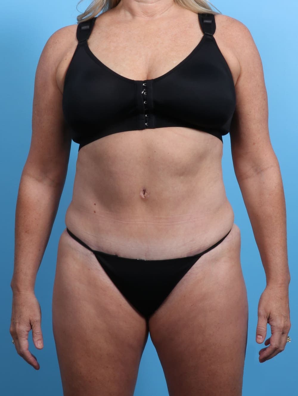Tummy Tuck case #2833 after