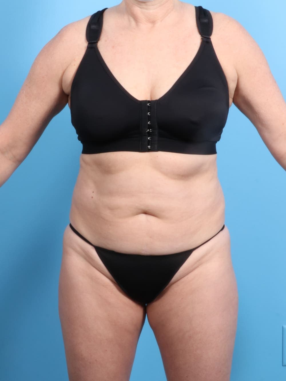 Tummy Tuck case #2833 before