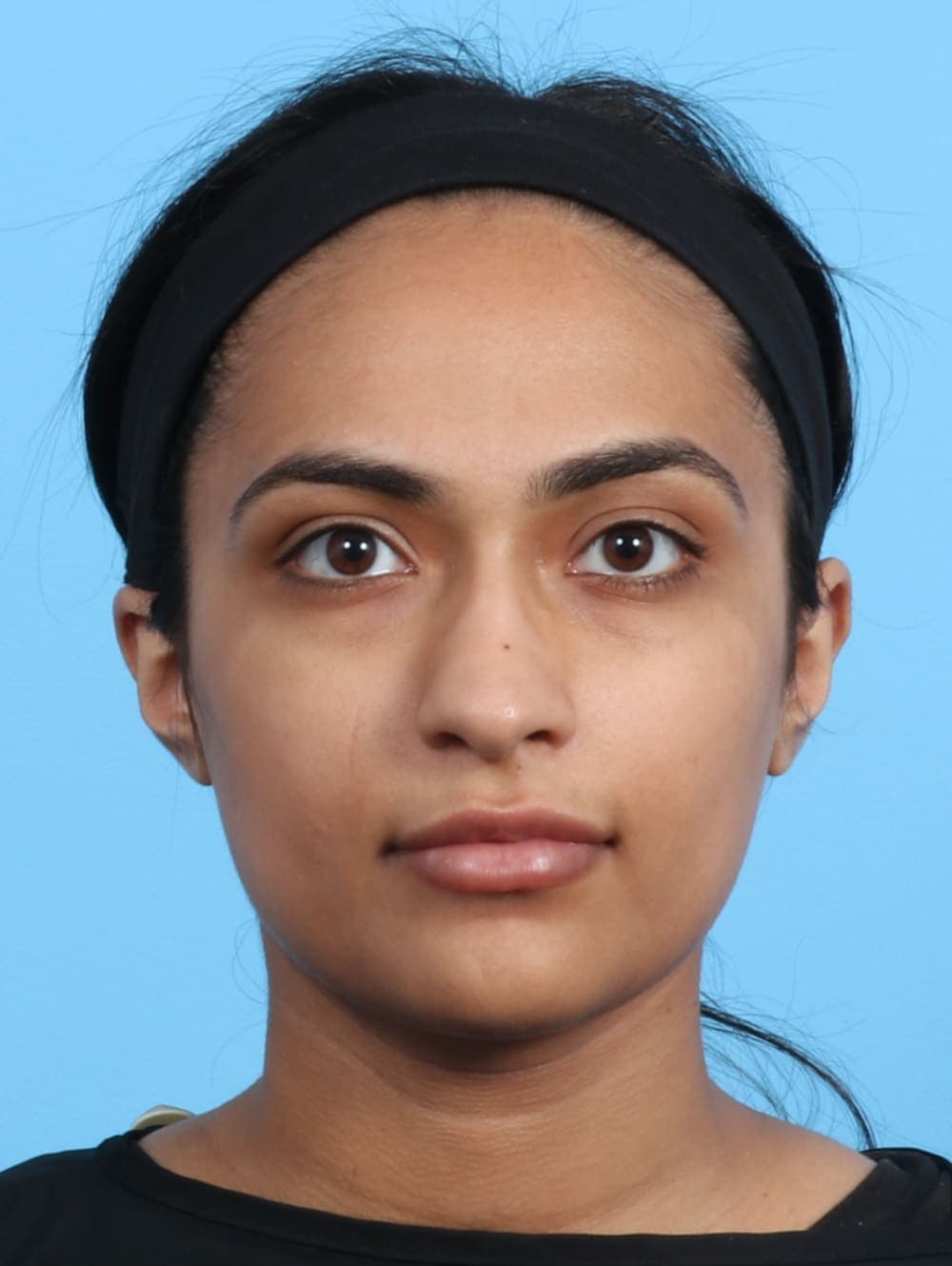 Rhinoplasty case #2979 before, image 2