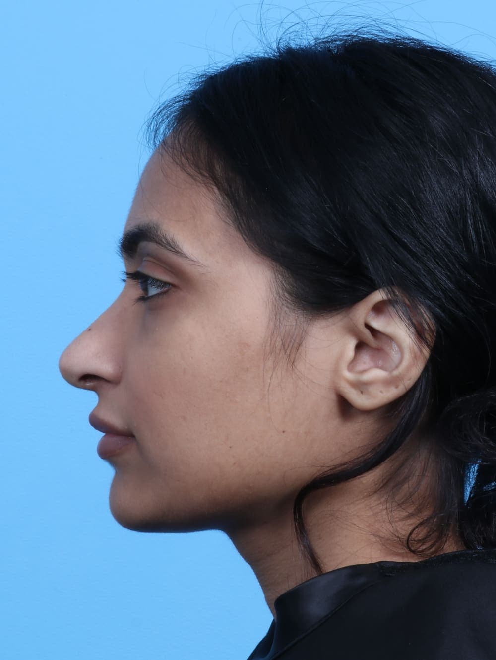 Rhinoplasty case #2979 after, image 1